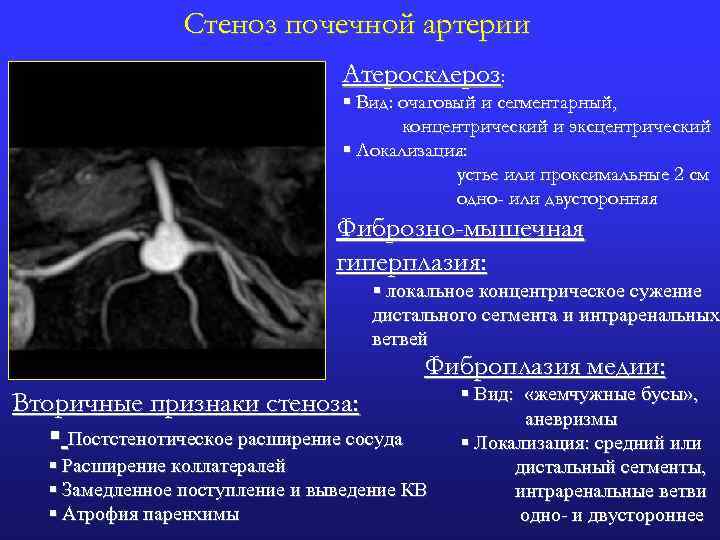 Осложнения стеноза. Сужение почечной артерии симптомы. Стеноз почечной артерии на УЗИ. Стеноз почечной артерии симптомы. Фибромускулярный стеноз.