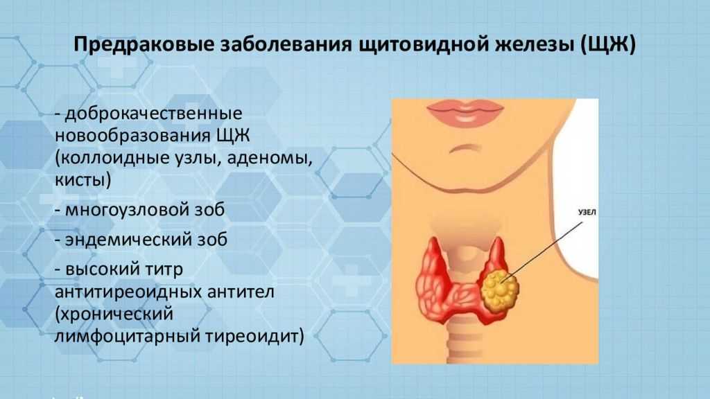 Узловое образование в доле щитовидной железы