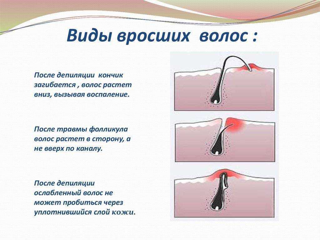 Как избавиться от вросших волос после эпиляции