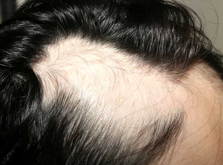 Выпадение волос кругами на голове у женщин