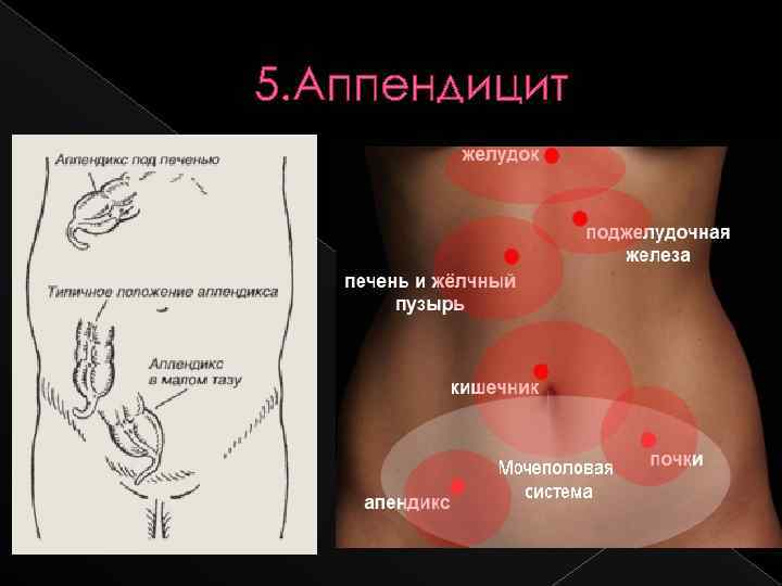 Острый аппендицит: сдать анализ в лаборатории kdlmed
