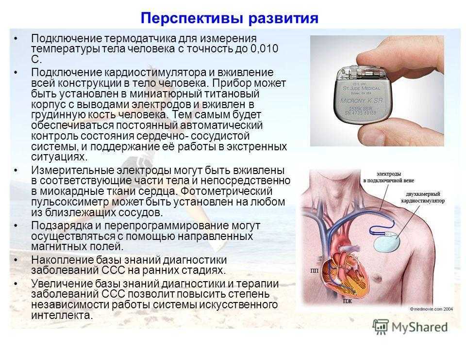 Сколько живут с кардиостимулятором. Кардиостимулятор сердца. Установленный кардиостимулятор. Электрокардиостимулятор экс-2.