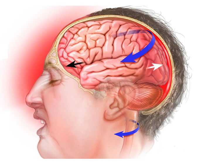 Закрытые травмы головы. Черепно мозговая травма сотрясение. Черепно-мозговая травма (ЧМТ). Черепно-мозговая травма (ЧМТ) сотрясение головного мозга (СГМ).