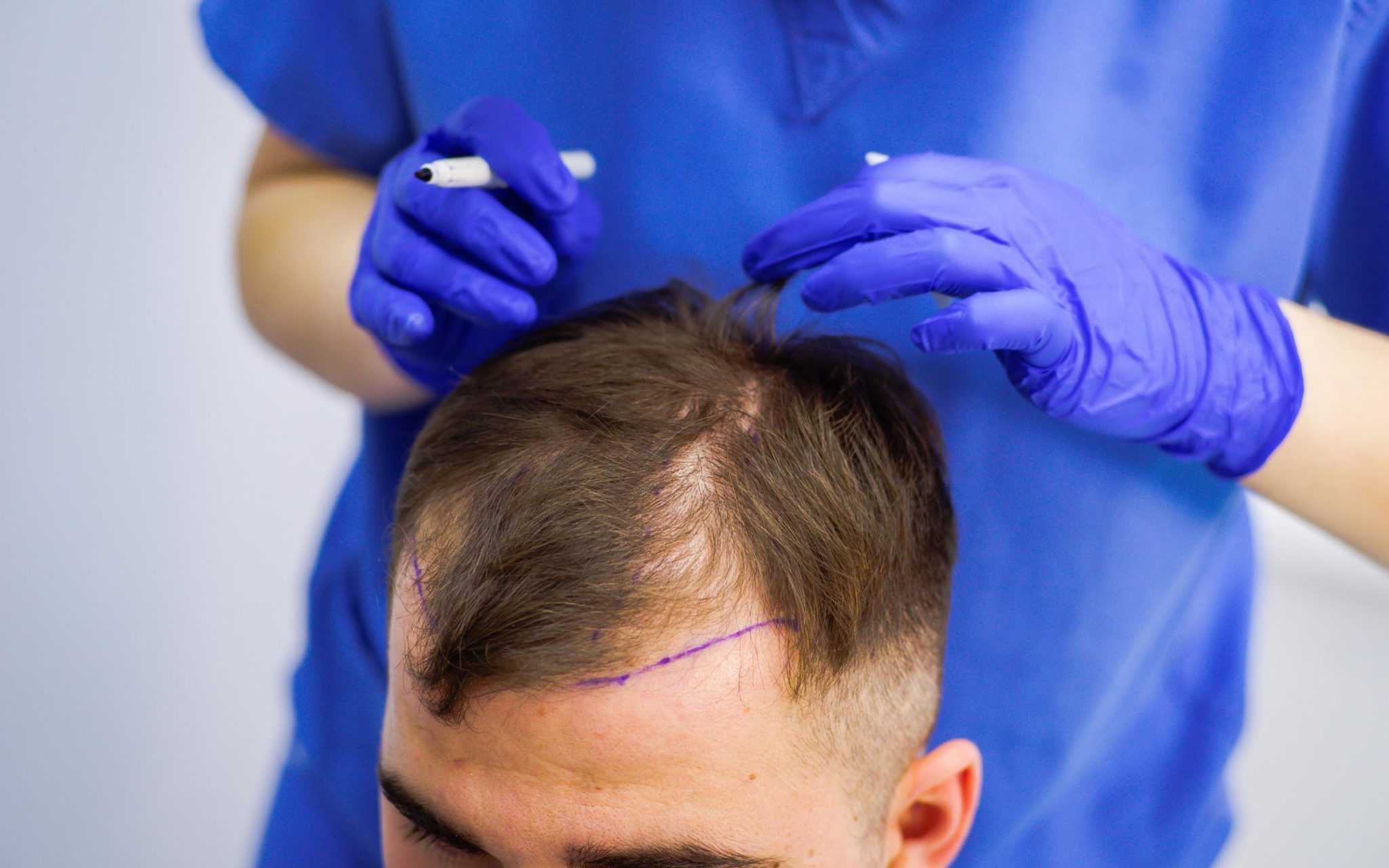 Что такое операция при выпадении волос