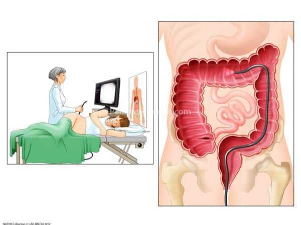 Колоноскопия кишечника картинки