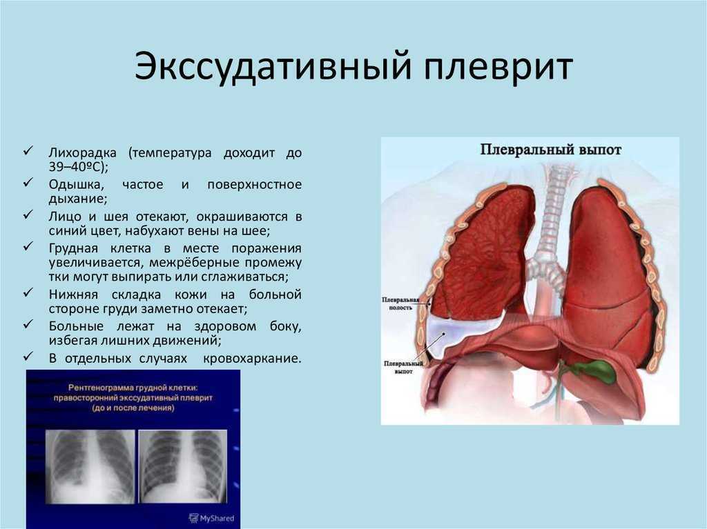 Отложение солей в суставах: артроз, кальциноз, подагра? - нолтрекс.