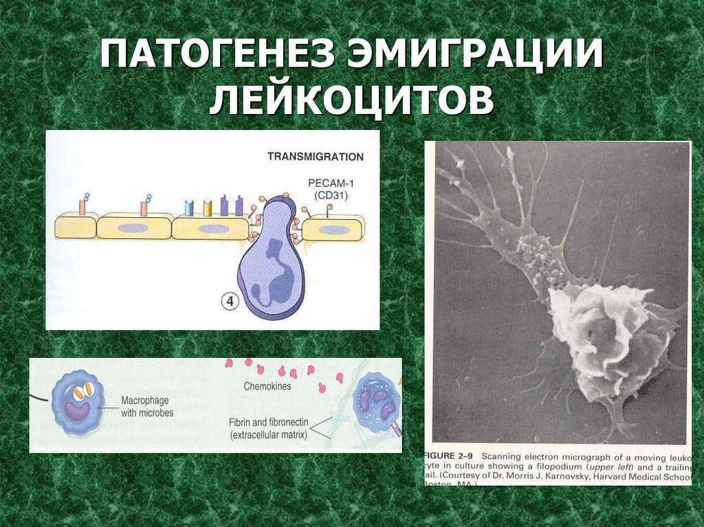 Эмиграция лейкоцитов это. Механизм развития эмиграции лейкоцитов. Патогенез эмиграции лейкоцитов. Эмиграция лейкоцитов патофизиология. Эмиграция лейкоцитов схема.