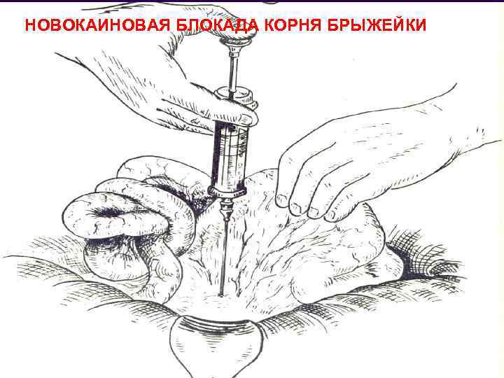 Блокада и перевязка семенного канатика у мужчин, показания и результат хирургического вмешательства | mfarma.ru