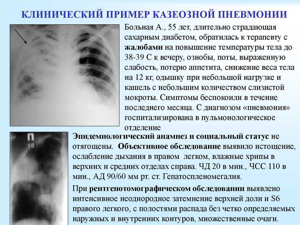 Острый милиарный туберкулез легких  - симптомы болезни, профилактика и лечение острого милиарного туберкулеза легких , причины заболевания и его диагностика на eurolab