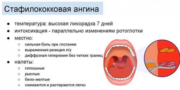 Схема лечения гнойной ангины