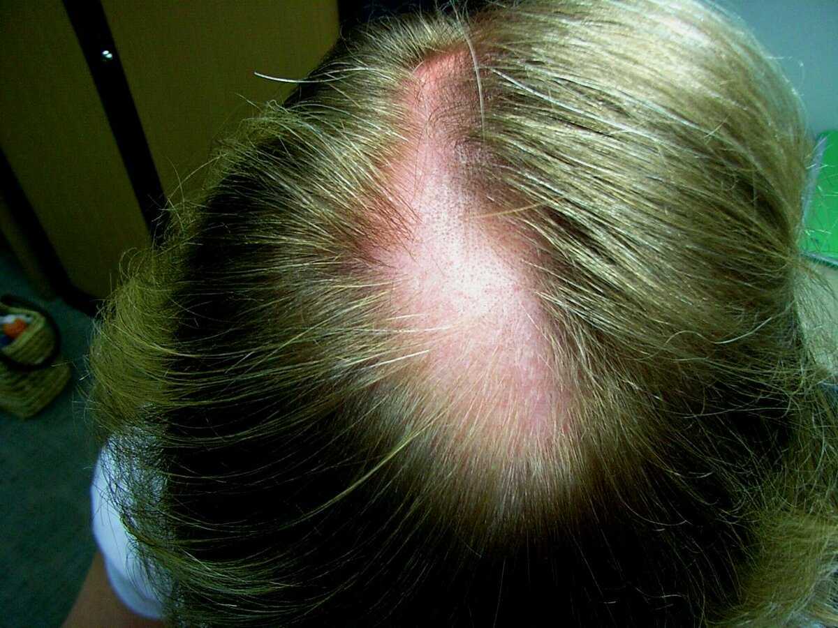 Жуткое выпадение волос может свидетельствовать о какой нибудь болезни