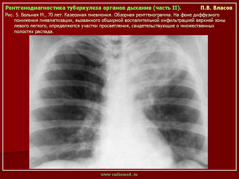 Диссеминированный туберкулез легких — риск заражения