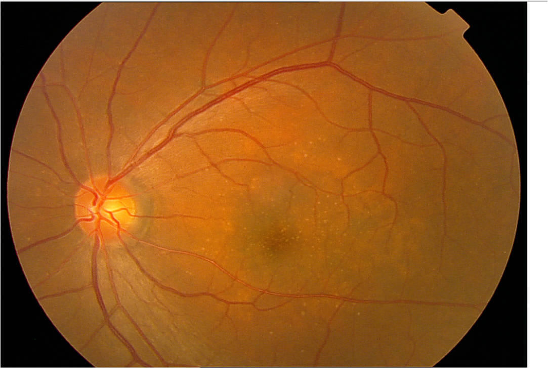 Гипертонический ангиосклероз сетчатки. Ангиосклероз сетчатки ou. Гипертоническая ретинопатия. Глаз ангиопатия сетчатки глаз. Миопический конус