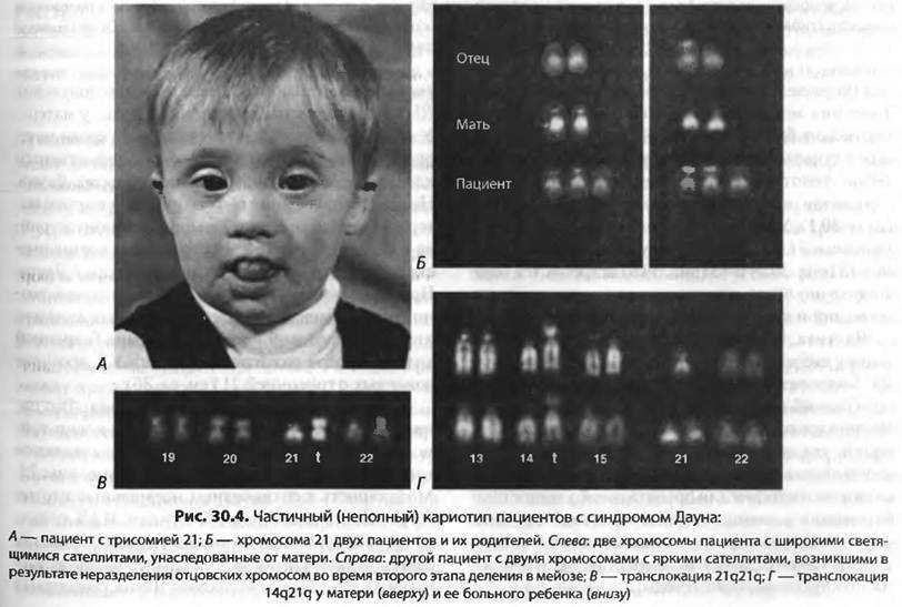 Синдром дауна код. Синдром Патау трисомия по 13 хромосоме. Синдром Дауна трисомия. Синдром Патау (трисомия в 13-Ой хромосоме);. Мозаичная трисомия синдрома Дауна.