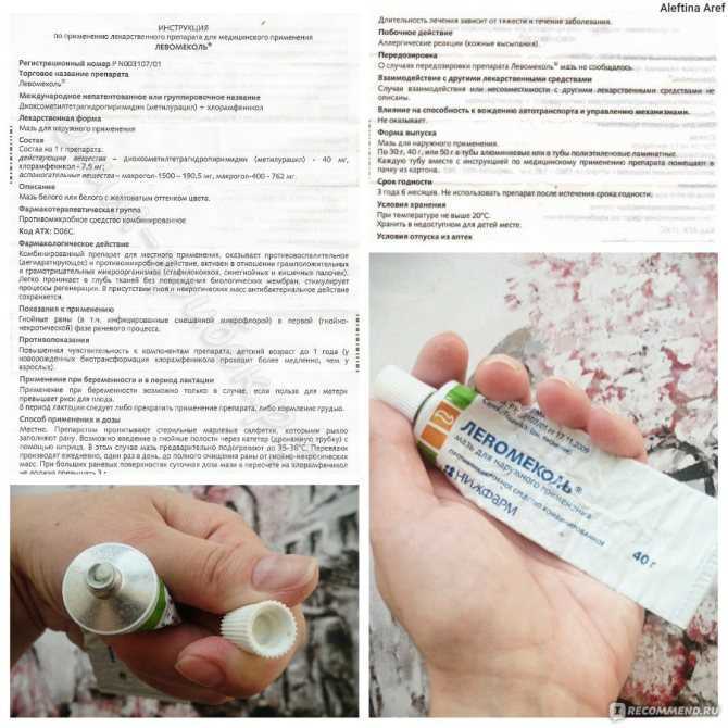 8 причин возникновения угревой сыпи у взрослых и эффективные методы лечения акне