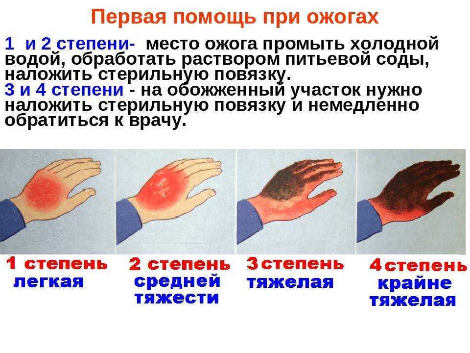 При ожоге третьей степени необходимо. Ожоги 1 степень 2 степень 3 степень 4 степень.