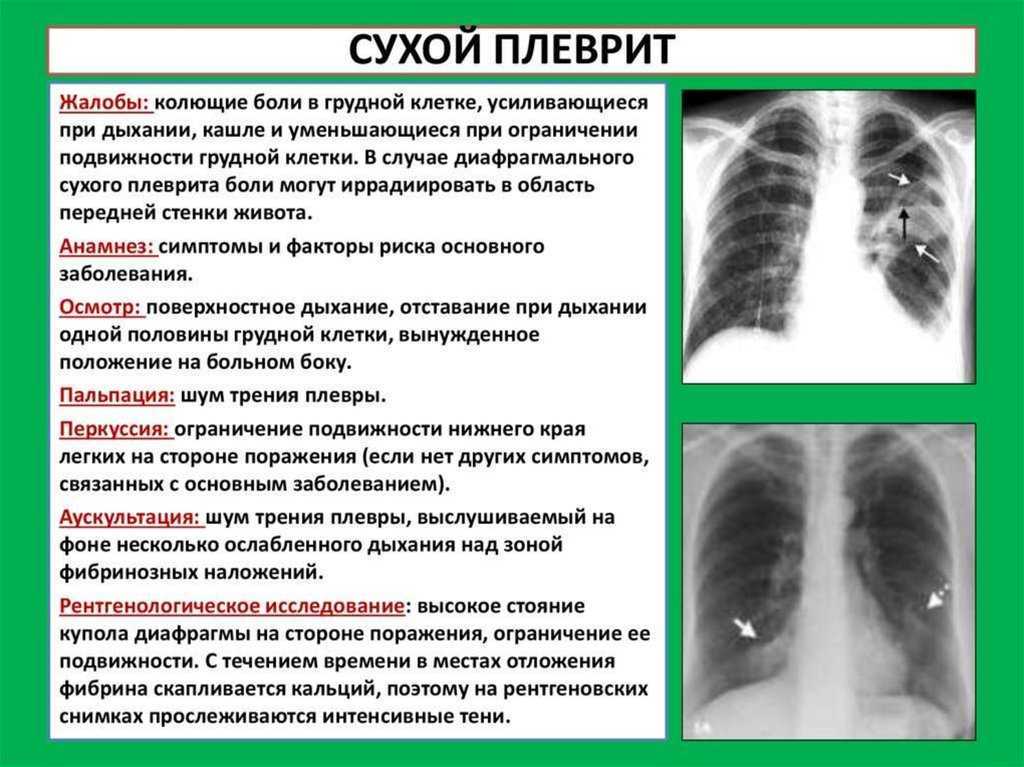 Плевральное дыхание. Сухой плеврит пропедевтика внутренних. Воспалительный процесс при Сухом плеврите характеризуется. Правосторонний сухой плеврит. Признак характерный для сухого плеврита.