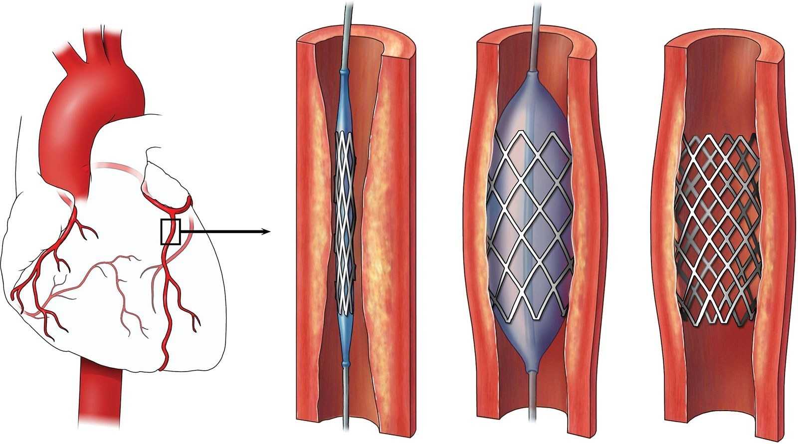 Что такое окклюзия бедренной артерии. методы лечения