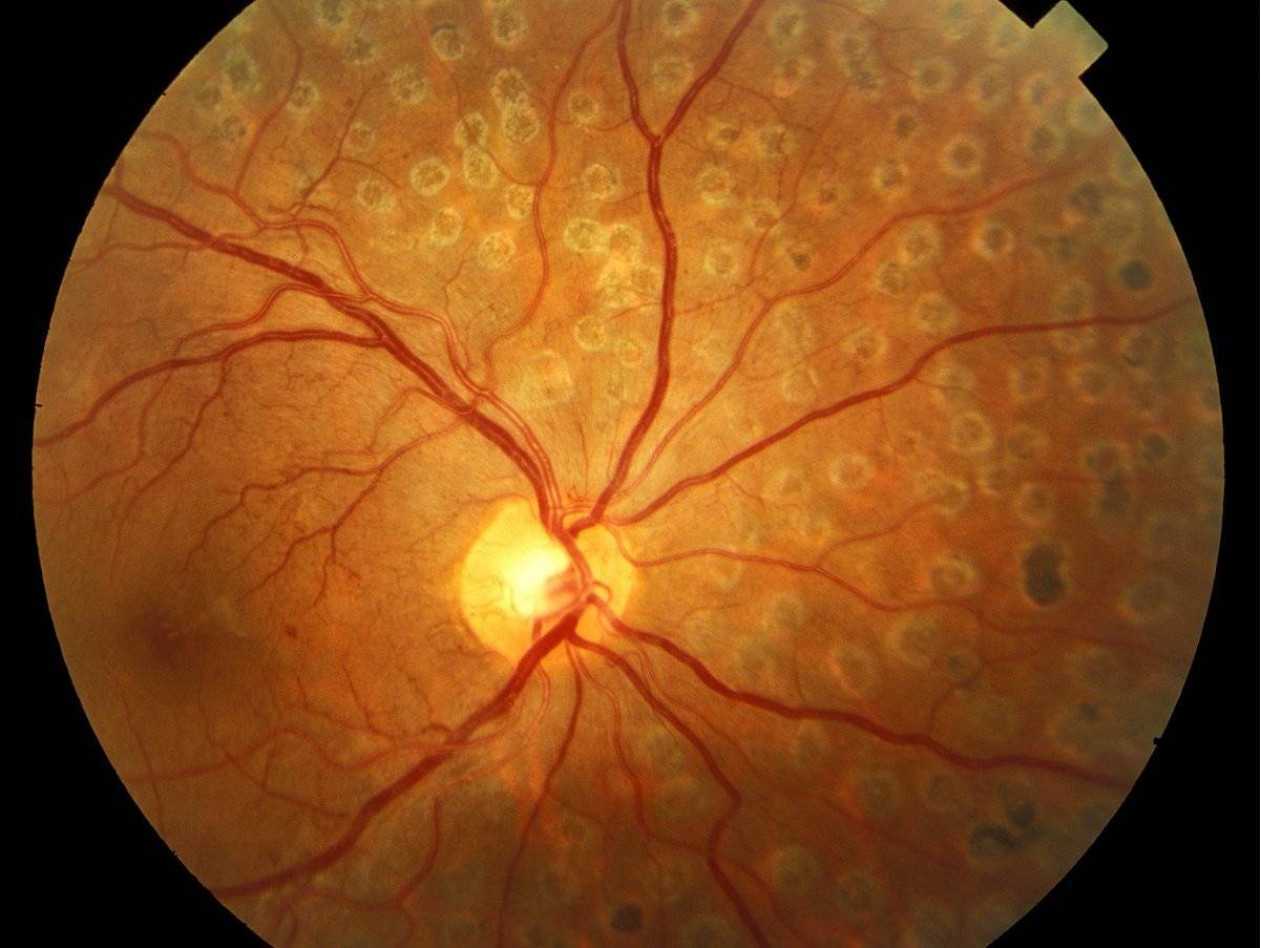 Ангиопатия сосудов сетчатки что это. Диабетическая ретинопатия глазное дно. Ангиопатия и ретинопатия сетчатки. Ретинопатия сетчатки глаза. Гипертоническая ангиопатия сетчатки глазное дно.