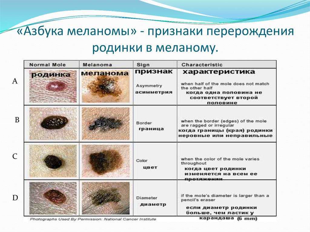 Невус. причины, симптомы, признаки, диагностика и лечение патологии :: polismed.com