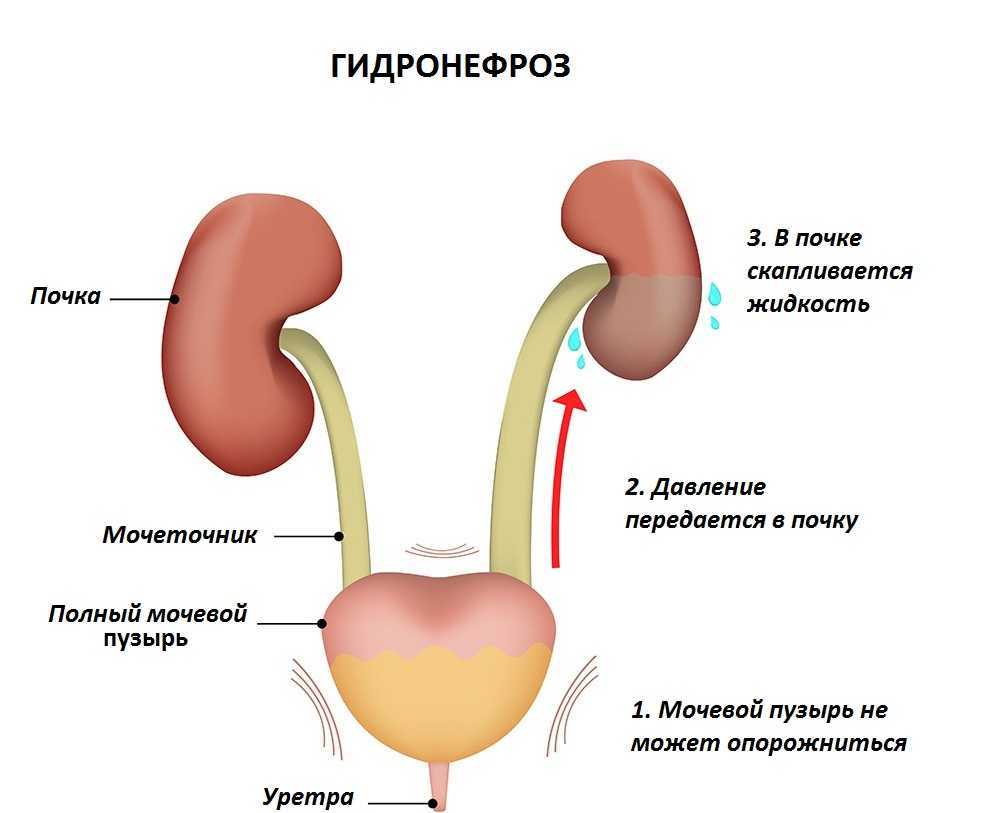 Гидронефроз почек лечение