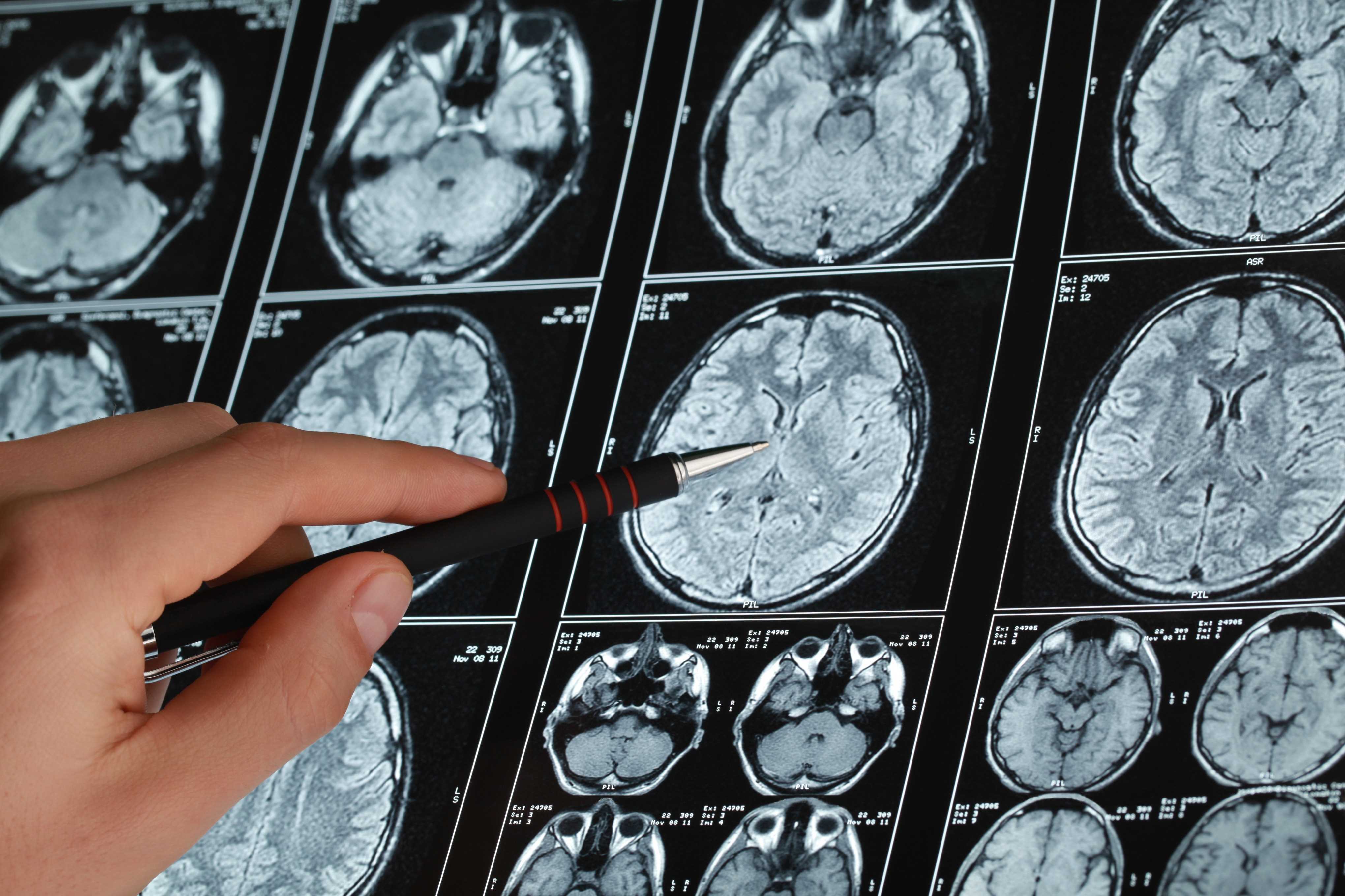 Мрт головного мозга опухоль. Снимки мрт головного мозга с опухолью. Опухоль головного мозга на кт. Опухоли головного мозга MRT. Опухоль головного мозга отек