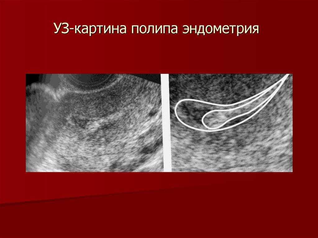 Полип шейки матки (цервикальный полипоз) – причины заболевания, профилактика и лечение