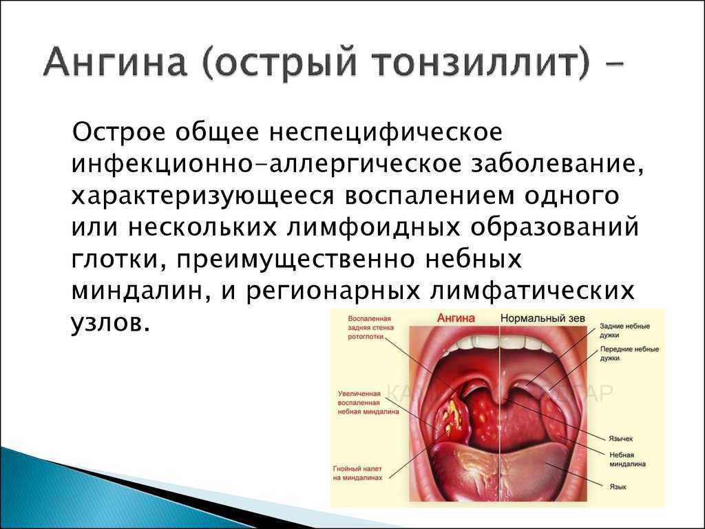 Ангина - клиника «к+31»