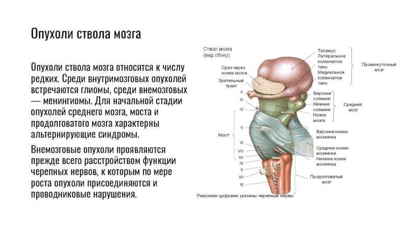 Опухоли мозга клиника. Диффузная глиома моста головного мозга. Опухоли моста и продолговатого мозга. Мозговой ствол.