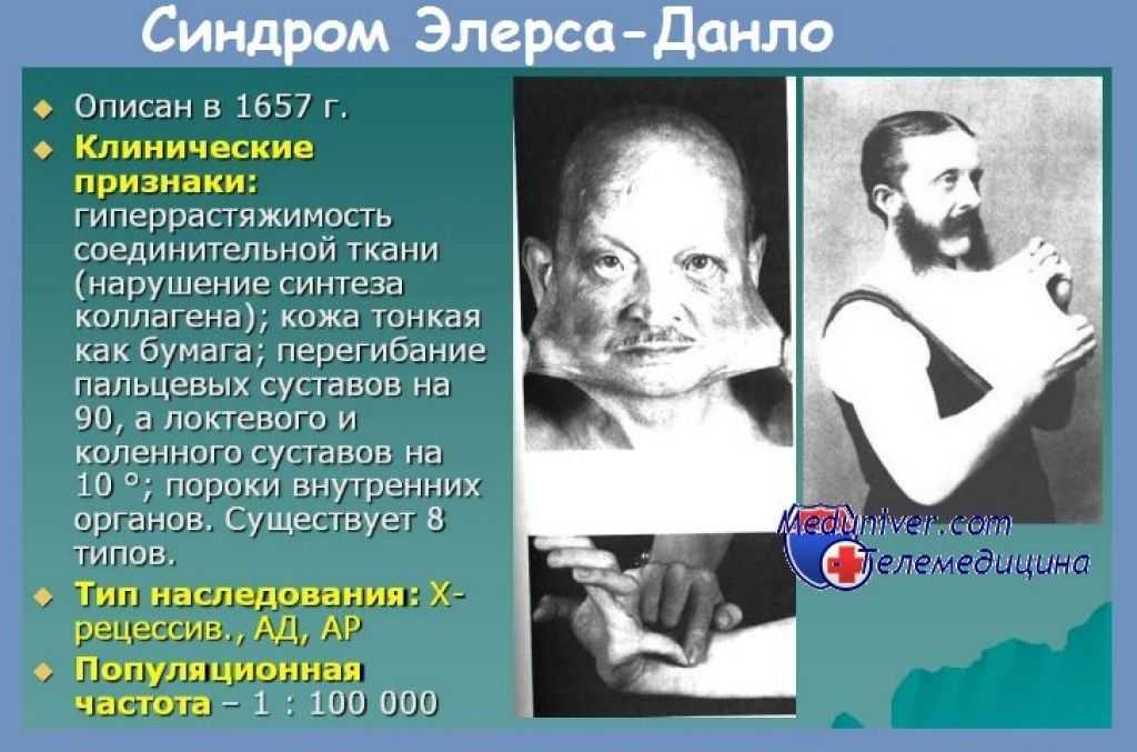 Аутоиммунные заболевания соединительной ткани