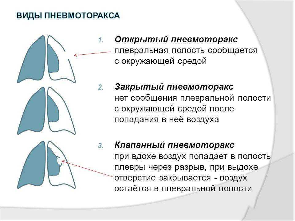 Физикальная картина при пневмотораксе характеризуется