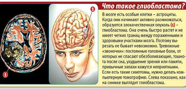 Симптомы глиобластомы головного. Глиобластома, неоперабельная опухоль головного мозга.. Опухоль головного мозга глиобластома 4. Симптомы глиобластомы головного мозга.