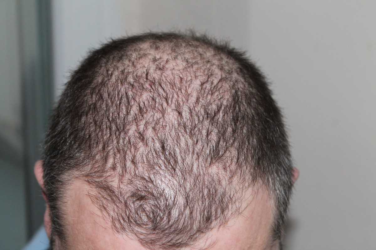 Почему волосы стали жесткими. Гнёздная (очаговая алопеция). Очаговая алопеция (alopecia Areata). Андрогенная алопеция алопеция.