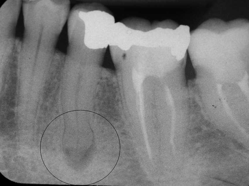 Рентгенологическая картина периодонтита