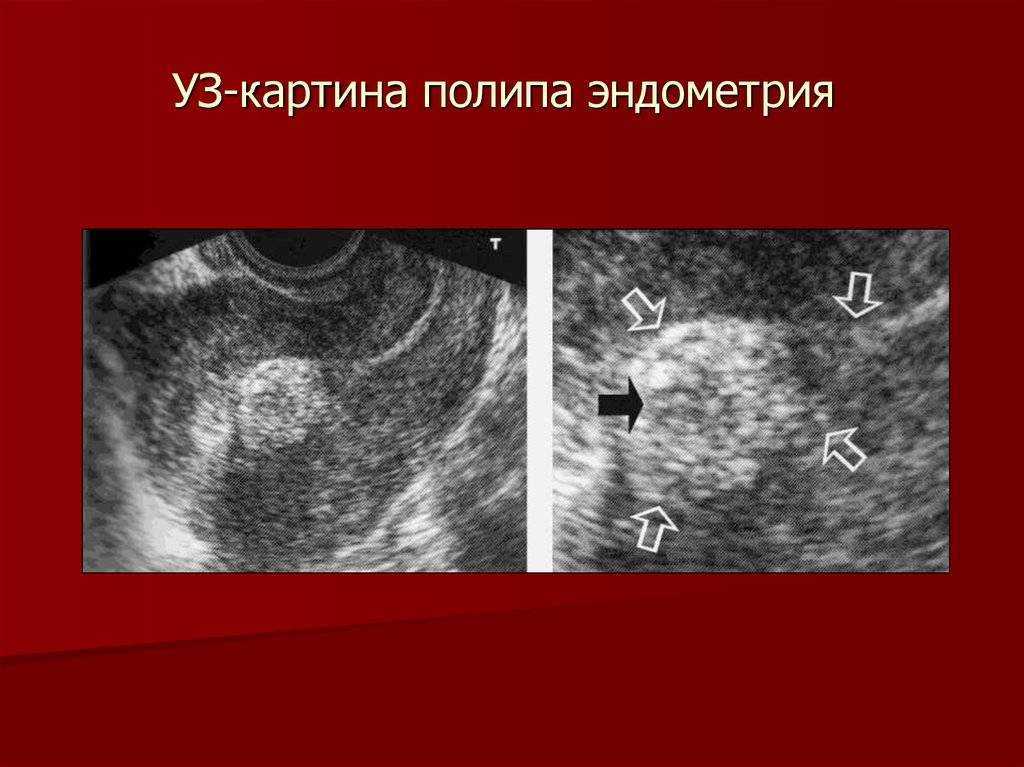 Удаление полипа матки в красняосрке | андро-гинекологическая клиника, ооо.