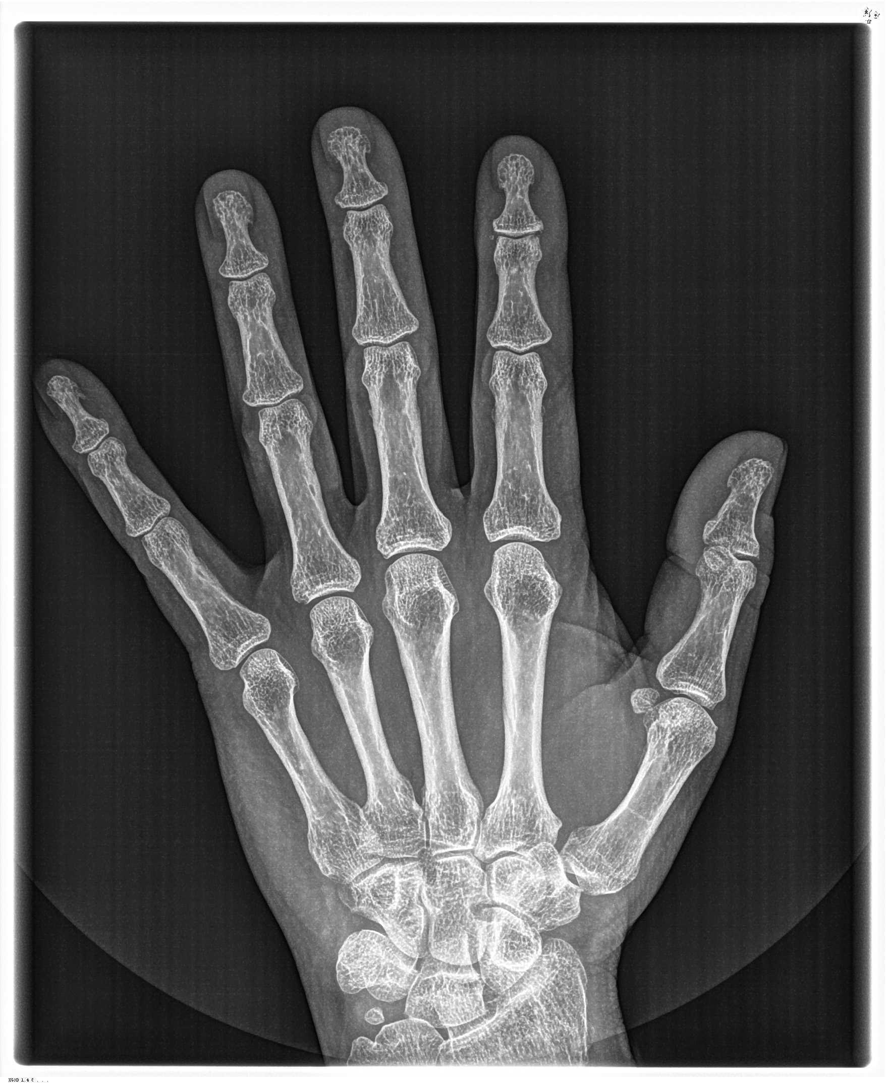 Снимок кисти руки рентген здорового человека фото