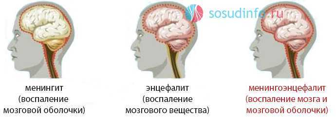 Инфекции головного мозга | неврология | заболевания