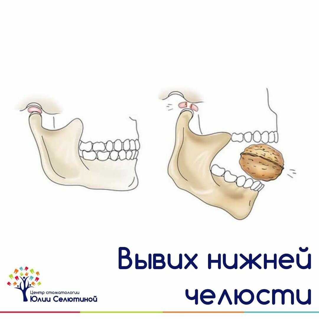 Вывих нижней челюсти презентация