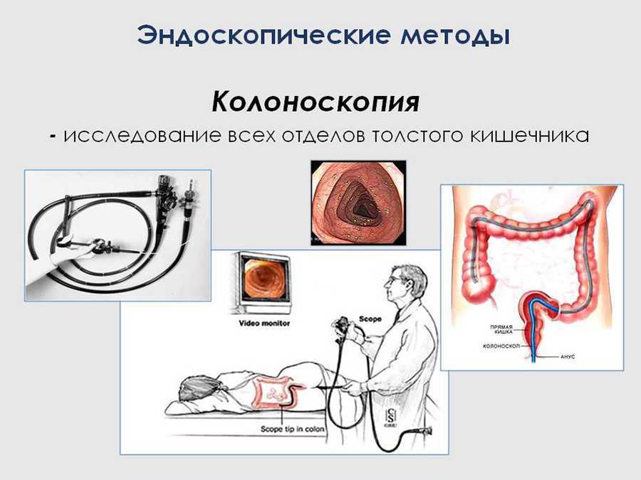 Путь продвижения эндоскопа при колоноскопии рисунок