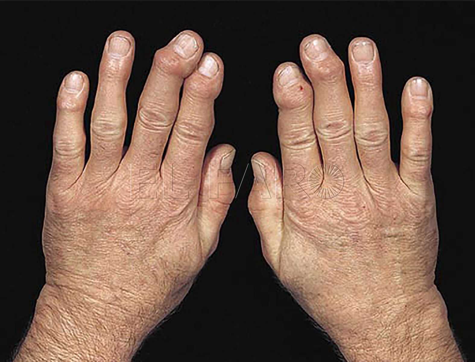 Artritis infecciosa tratamiento