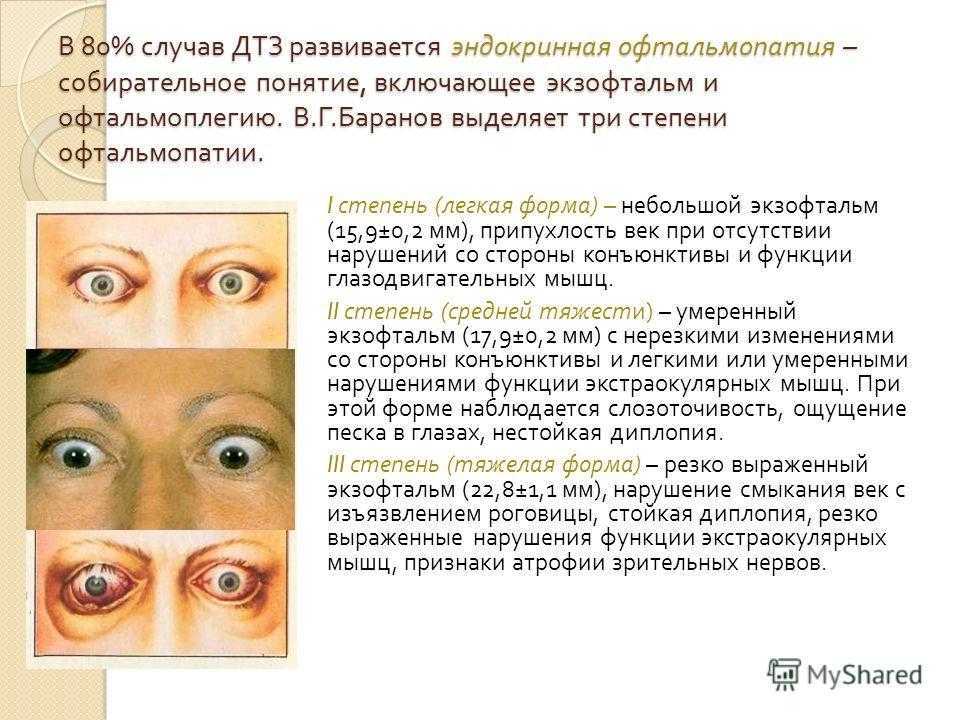 Экзофтальм наблюдается при. Глазные симптомы эндокринной офтальмопатии. Эндокринная офтальмопатия стадии. Классификация эндокринной офтальмопатии. Эндокринная офтальмопатия птоз.