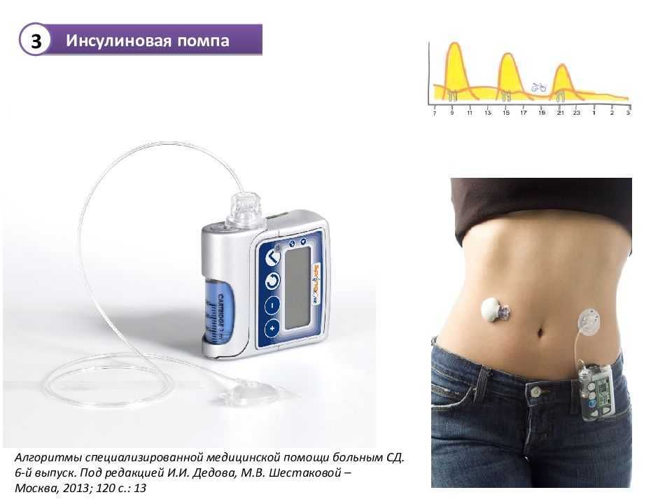 Инсулиновые помпы презентация
