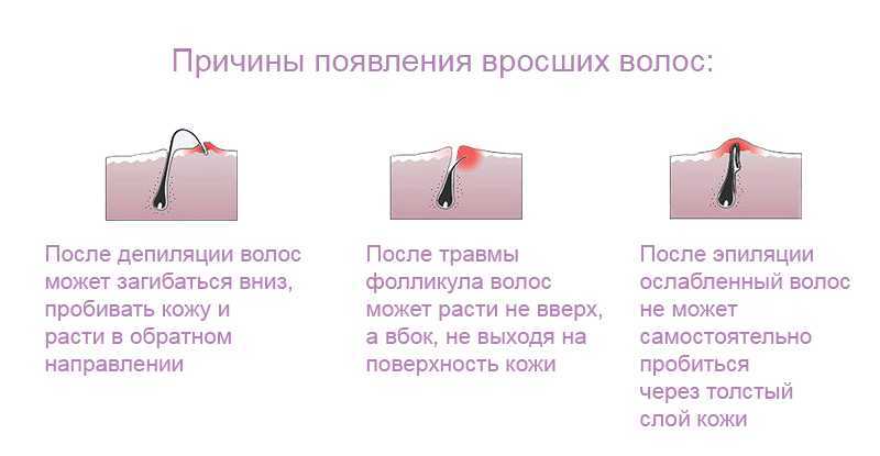 Трихотилломания (выдергивание волос) как психическое заболевание
