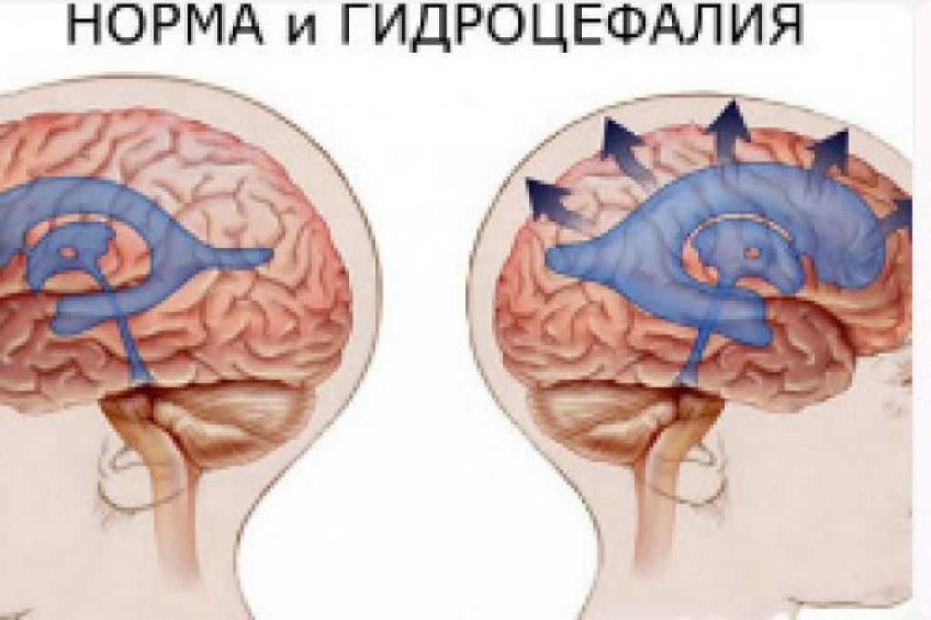 Причины гидроцефалии мозга. Врожденные патологии. Гидроцефалия.. Внутренняя гидроцефалия головного мозга. Обтурационная гидроцефалия. Гидроцефалия головного мозга у ребенка.