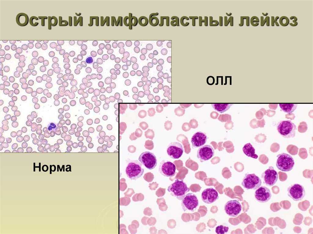 Картина острого лейкоза