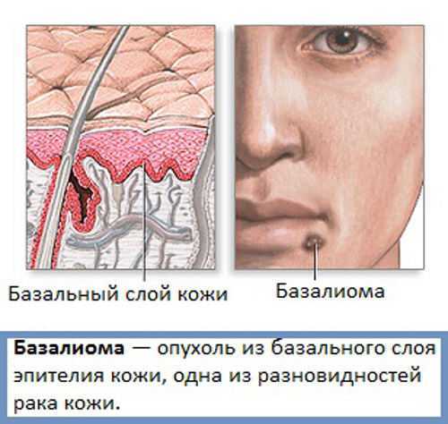 Пациентов с новообразованиями кожи. Фиброзирующая базалиома. Базосквамозная базалиома. Травмированная базалиома.