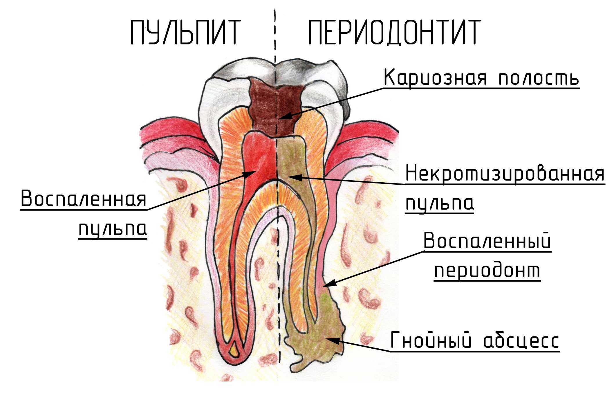Пульпит периодонтит зубов