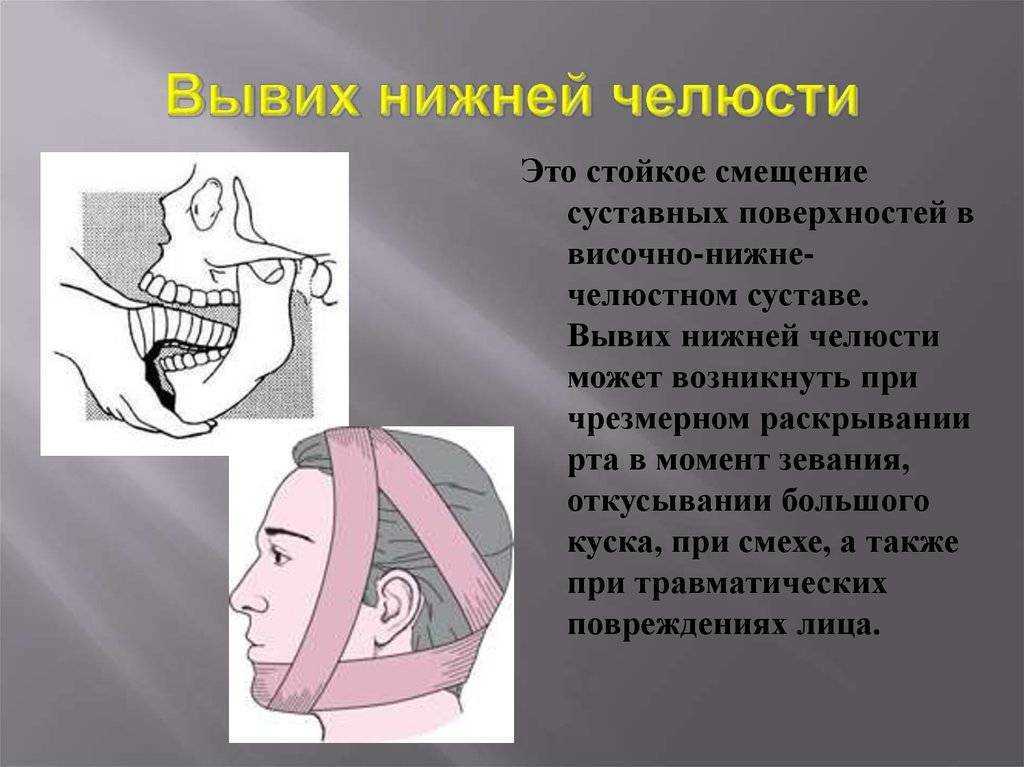 Подвывих челюсти симптомы. Клинические симптомы вывиха нижней челюсти. Вивыхи нижней челюстей. Передний односторонний вывих нижней челюсти. Односторонний вывих челюсти.