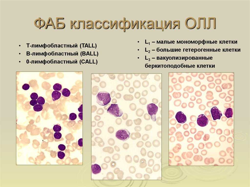 Лимфобластный лейкоз. Острый лимфобластный лейкоз л1. 1. Острый лимфобластный лейкоз. Острый лимфобластный лейкоз клетки. Острый лимфобластный лейкоз l2.