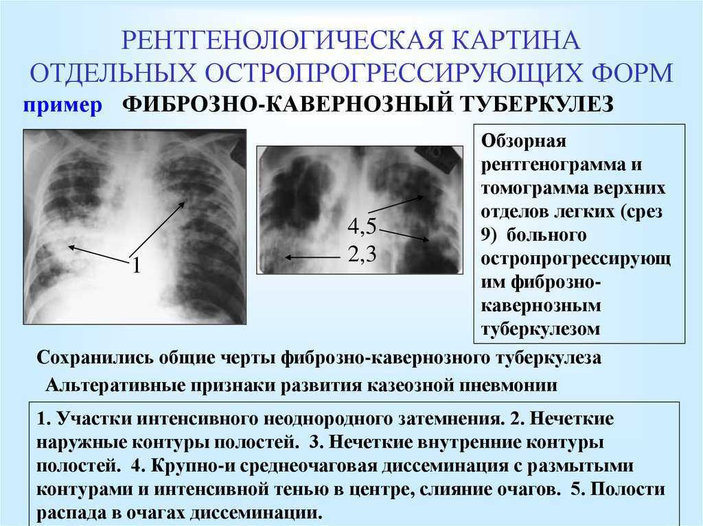 Рентгенологическая диагностика диссеминированного туберкулёза лёгких выявляет преобладающий синдром диссеминированного туберкулёза лёгких - очаговая